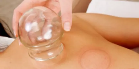 Cupping Therapy Delhi