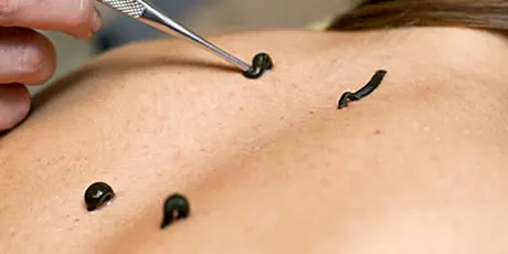 Raktamokshan benefits and cost